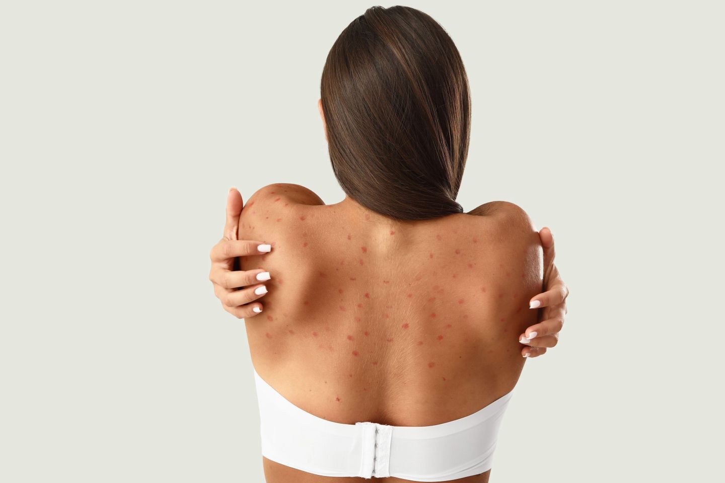 Creștere alarmantă a cazurilor de varicelă în rândul adulților: avertismentul medicilor