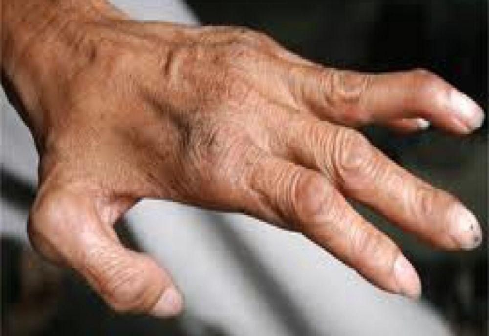 Alertă sanitară la Cluj, după depistarea a două cazuri de lepră la un centru SPA. Aproape 2.000 de clienți, notificați de DSP